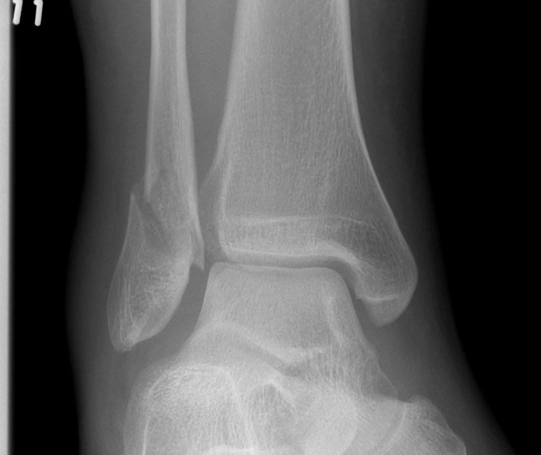 Isolated Fibula Fracture 3 mm displaced